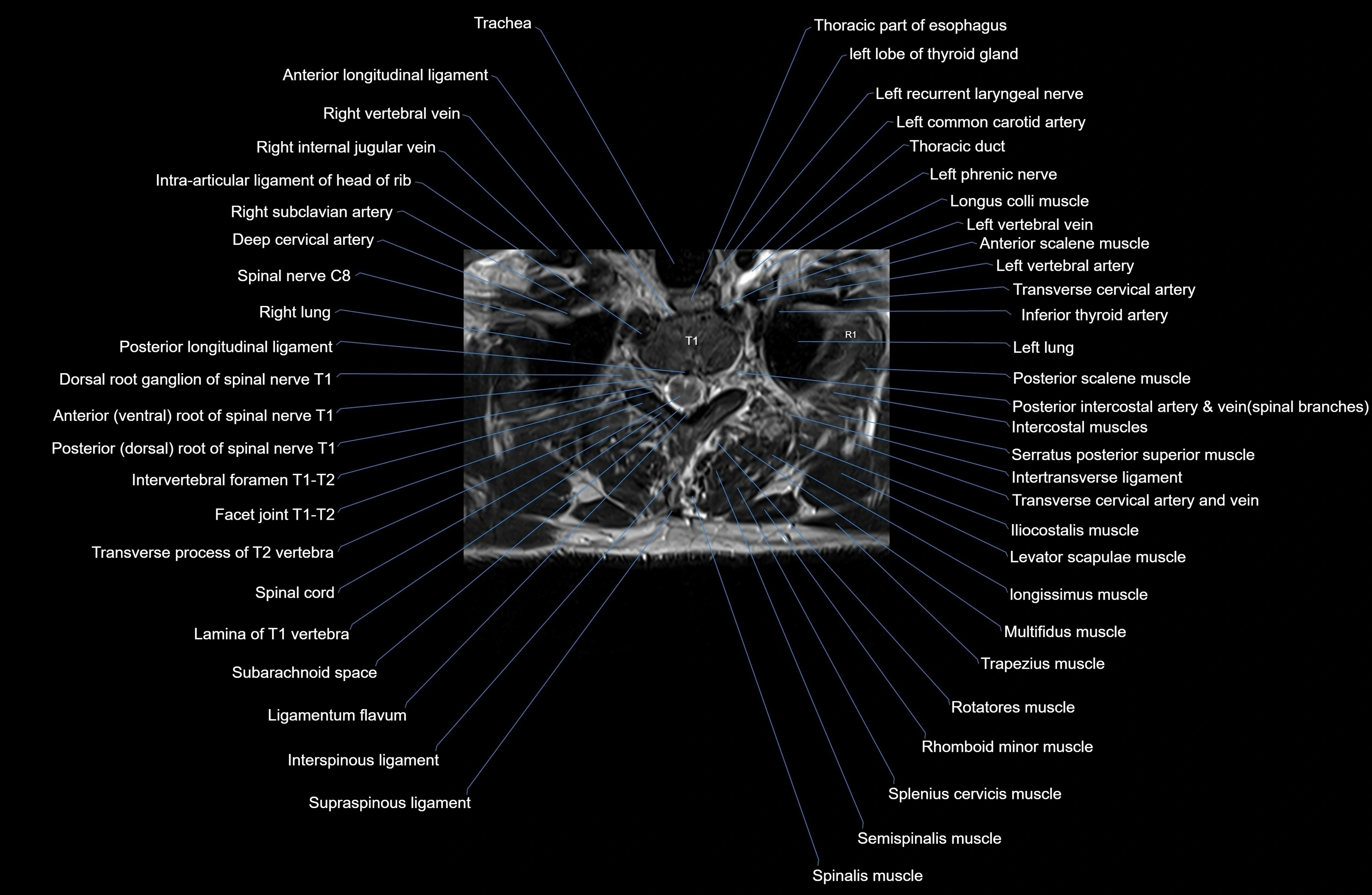 MRI thoracic spine axial  cross sectional anatomy 3T radiology  image-img-00001-00010.webp